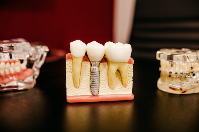 The Evolution of Smiles – Exploring the Advancements in Implant Dentistry